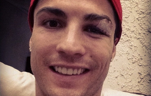 Mắt sưng húp, Ronaldo vẫn 'cười tít' khoe ảnh